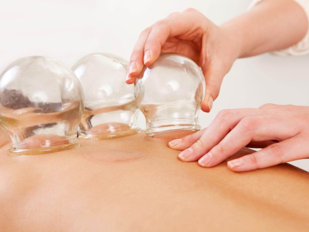 Woman undergoing Cupping Therapy
